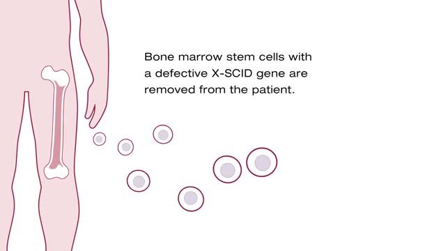 How gene therapy works to treat patients with X-linked SCID. How gene therapy works to treat patients with X-linked SCID.