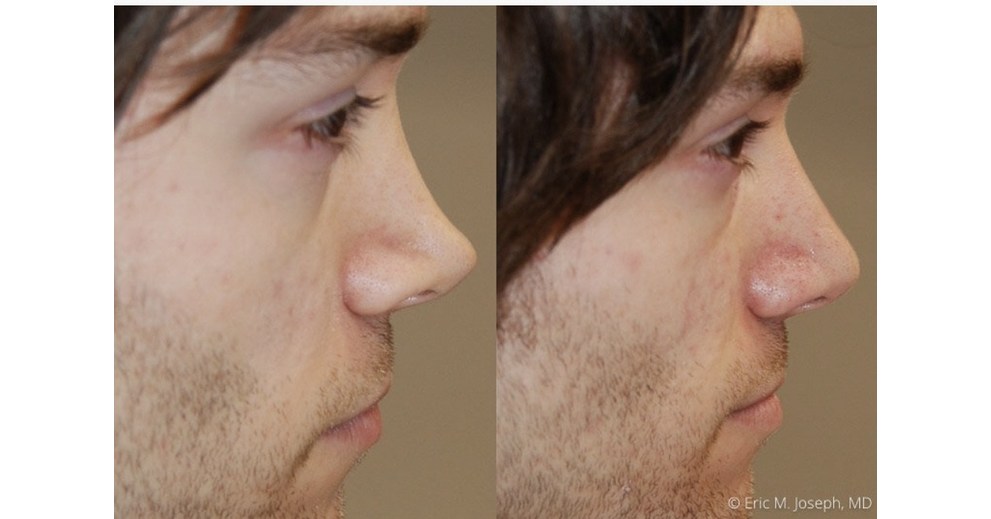 /PRNewswire/ -- The non-surgical nose job is a little-known beauty savior p...