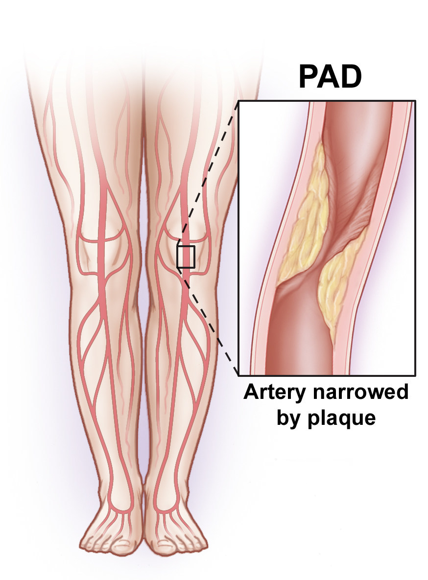 Артерия ноги операция. Атеросклероз сосудов нижних конечностей. Облитерирующий атеросклероз артерий нижних конечностей ноги. Шунтирование вен нижних конечностей. Атеросклеротическое поражение сосудов нижних конечностей.