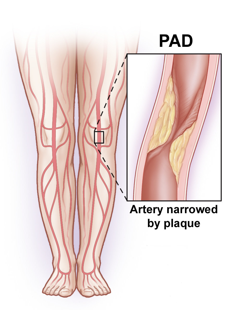 Атеросклеротическое поражение нижних конечностей